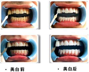 醫生有你 牙齒美白會有什么危害嗎